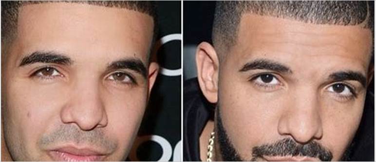 Drake plastic surgery